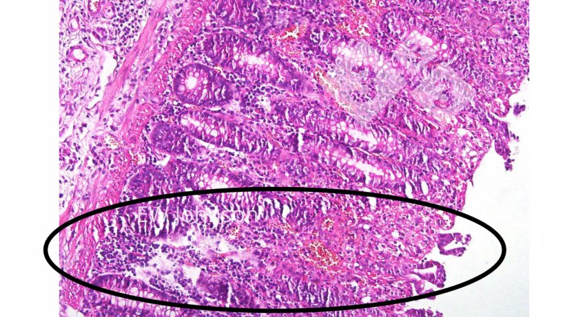 Foto 4. Trombose vascular, infarto, ulcera&ccedil;&atilde;o na mucosa do c&oacute;lon.
