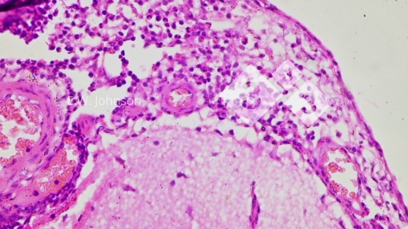 Imagem&nbsp;3. Meningite com c&eacute;lulas mononucleares e algumas c&eacute;lulas polimorfonucleares. C&eacute;rebro.
