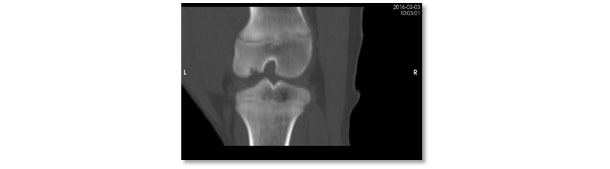 Vis&atilde;o de tomografia computadorizada da mesma les&atilde;o. Les&atilde;o grave de osteocondrose com aus&ecirc;ncia de ossifica&ccedil;&atilde;o na regi&atilde;o subarticular do c&ocirc;ndilo lateral do f&ecirc;mur.
