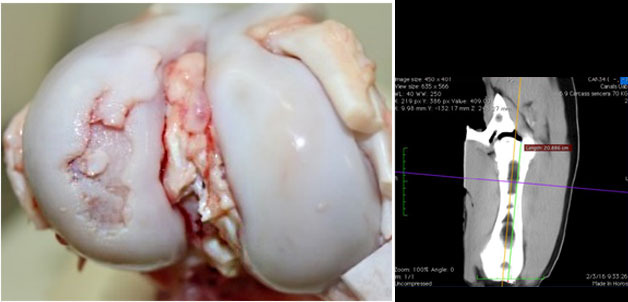 Vis&atilde;o macrosc&oacute;pica da articula&ccedil;&atilde;o do joelho com les&atilde;o de osteocondrose grave no c&ocirc;ndilo lateral do f&ecirc;mur.
