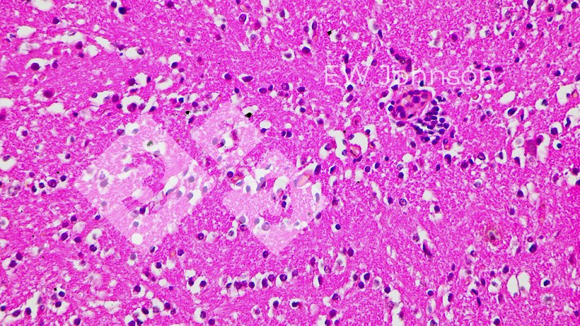 Figura 4.&nbsp;Encefalite cerebral com vasculite e neuronofagia.
