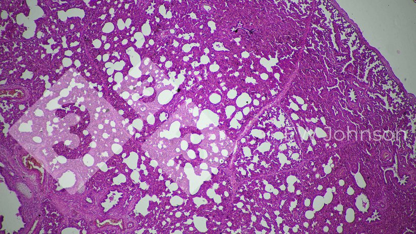 Figura 3.&nbsp;A pneumonia intersticial sugere uma poss&iacute;vel origem viral.
