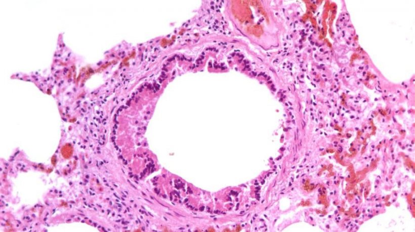 Figura 5: Bronquiolite necrotizante causada pela infec&ccedil;&atilde;o por SIV.
