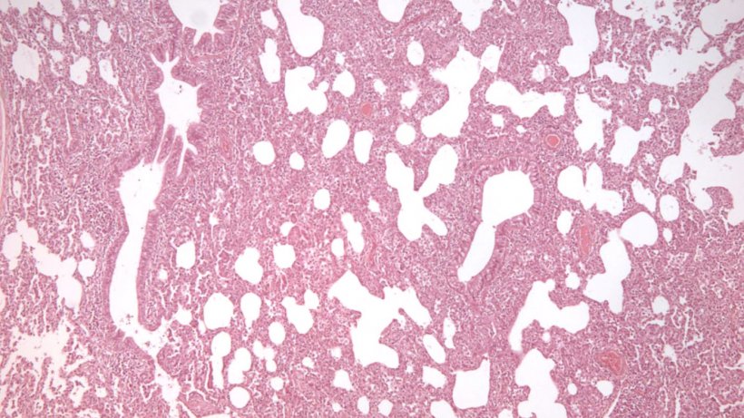 Figura 2: Pneumonia intersticial, caracterizada por espessamento dos septos alveolares, em uma infec&ccedil;&atilde;o por PRRSV.
