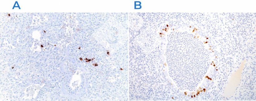 Figura 3. Imunohistoqu&iacute;mica para detec&ccedil;&atilde;o do v&iacute;rus da s&iacute;ndrome reprodutiva e respirat&oacute;ria su&iacute;na (PRRSV) (A) e do v&iacute;rus da gripe su&iacute;na (B). A presen&ccedil;a do ant&iacute;geno viral (colora&ccedil;&atilde;o marrom) &eacute; encontrada nas &aacute;reas afetadas.
