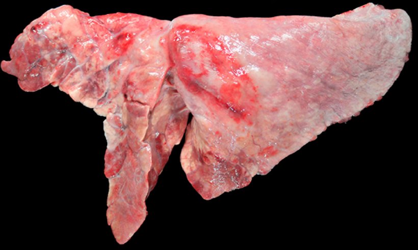 Figura 5: Pulm&atilde;o de su&iacute;no&nbsp;coinfectado com M. hyopneumoniae e A. pleuropneumoniae. &Aacute;reas marrom-avermelhadas de consolida&ccedil;&atilde;o cranioventral, causadas por infec&ccedil;&atilde;o por M. hyopneumoniae, e les&atilde;o ovalada com fibrose pleural e &aacute;reas hemorr&aacute;gicas no lobo diafragm&aacute;tico, que corresponderiam &agrave; cronicidade de um foco de necrose produzido por A. pleuropneumoniae.
