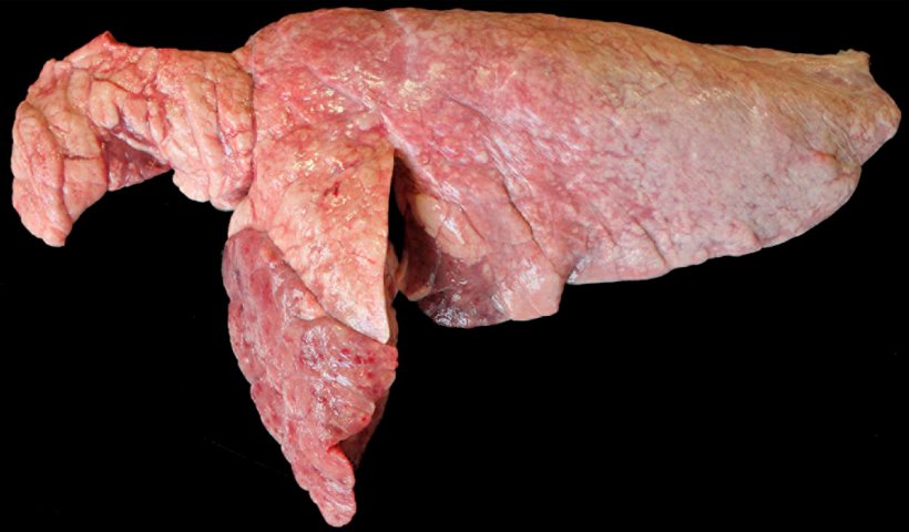 Figura 6. Pulm&atilde;o de su&iacute;no coinfectado com M. hyopneumoniae e P. multocida. &Aacute;reas marrom-avermelhadas de consolida&ccedil;&atilde;o cranioventral elevadas em rela&ccedil;&atilde;o ao restante do par&ecirc;nquima pulmonar que corresponderiam a uma les&atilde;o de P. multocida. No lobo cranial e na borda cranioventral do lobo caudal, observam-se &aacute;reas de consolida&ccedil;&atilde;o avermelhadas e de aspecto deprimido, correspondentes a les&otilde;es causadas por M. hyopneumoniae.
