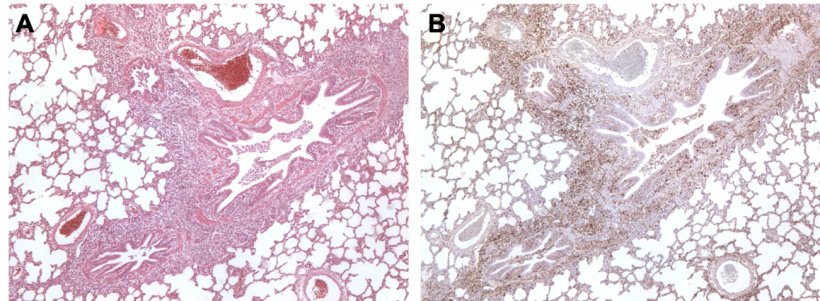 Figura 3. Pulm&atilde;o de su&iacute;no coinfectado com M. hyopneumoniae e PCV2. A: &Aacute;rea de hiperplasia linfoide peribronquiolar causada por M. hyopneumoniae. B: Grande quantidade de ant&iacute;geno PCV2 na mesma &aacute;rea de hiperplasia linfoide.
