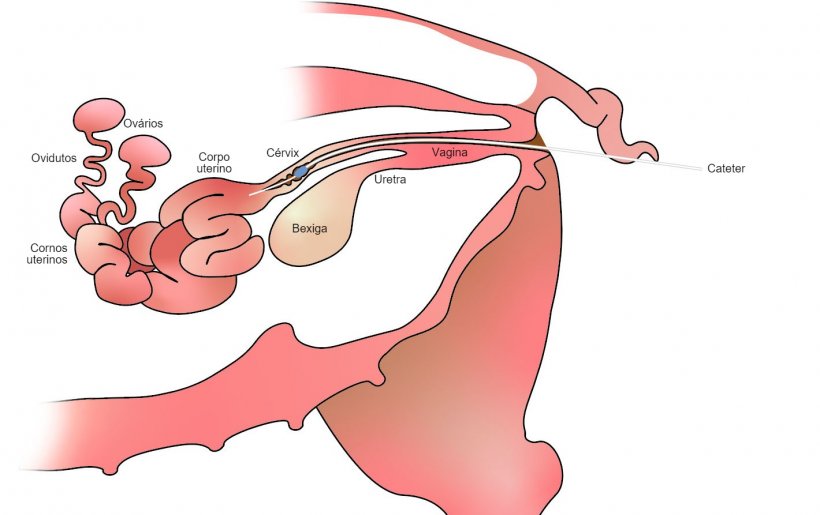 Figura 1. Com a insemina&ccedil;&atilde;o p&oacute;s-cervical, o s&ecirc;men &eacute; depositado no corpo uterino, ap&oacute;s o colo do &uacute;tero.
